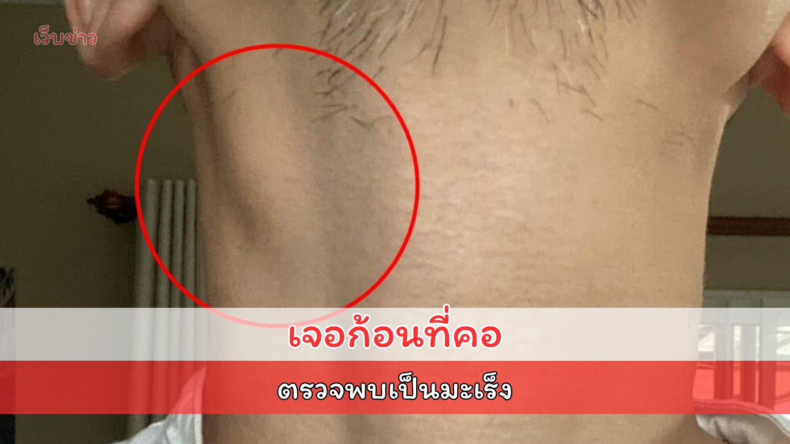 หมอฟัน แชร์ประสบการณ์ เป็น มะเร็งโพรงจมูก คลำเจอก้อนที่คอ ก่อนพบโรคร้าย